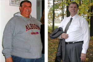 Rick_weight_loss_sugery_before_after Before and after weight loss surgery