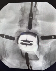 Cervical total disc replacement